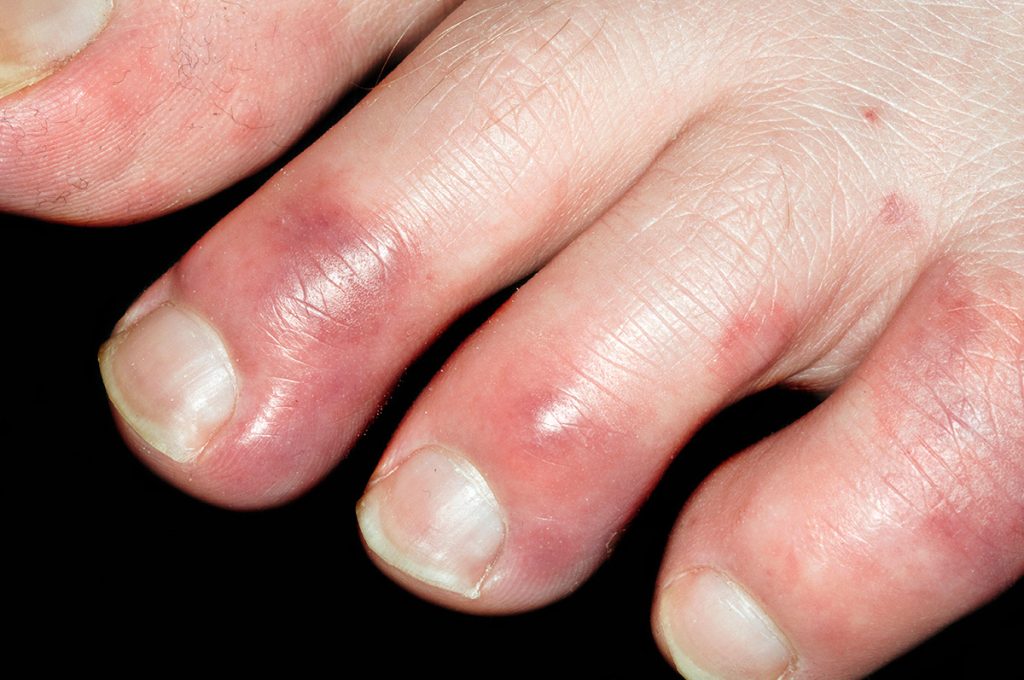 Chilblains
